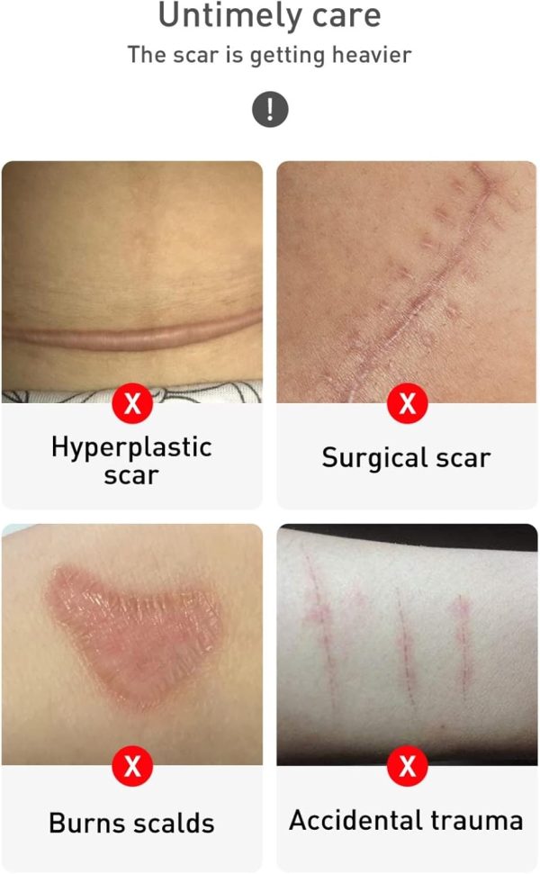 ⁦كريم جل مزيل للندبات بتركيبة اعشاب لاخفاء الندوب وعلامات حب الشباب وتغذية الجافة وتجديد الرطوبة والترطيب العميق للبشرة 30 مل من نوفولان⁩ - الصورة ⁦2⁩