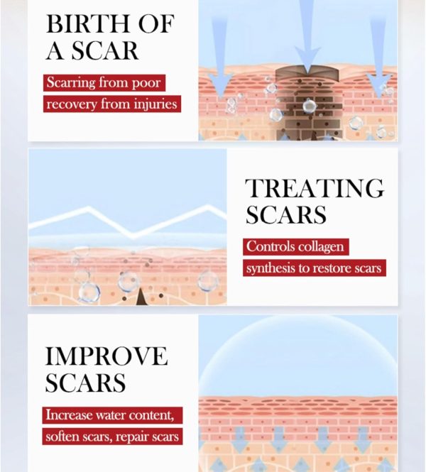 ⁦كريم جل متطور للندوب الجراحية وعلامات التمدد وحب الشباب والاصابات والجدرة واكثر - ذلك فعال لكل - الندوب القديمة والجديدة - الميكاكوز احترافي لازالة 3⁩ - الصورة ⁦4⁩