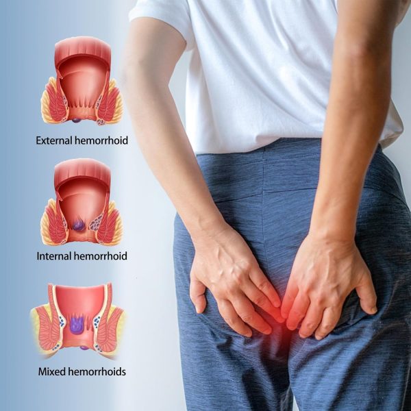 ⁦كريم البواسير من هونبولو - مرهم فعال لعلاج للاكوام الداخلية والخارجية يخفف التورم والحكة والالم وعدم الراحة جل مهدئ وشفاء للعناية بالشرج 20 غرام⁩ - الصورة ⁦5⁩