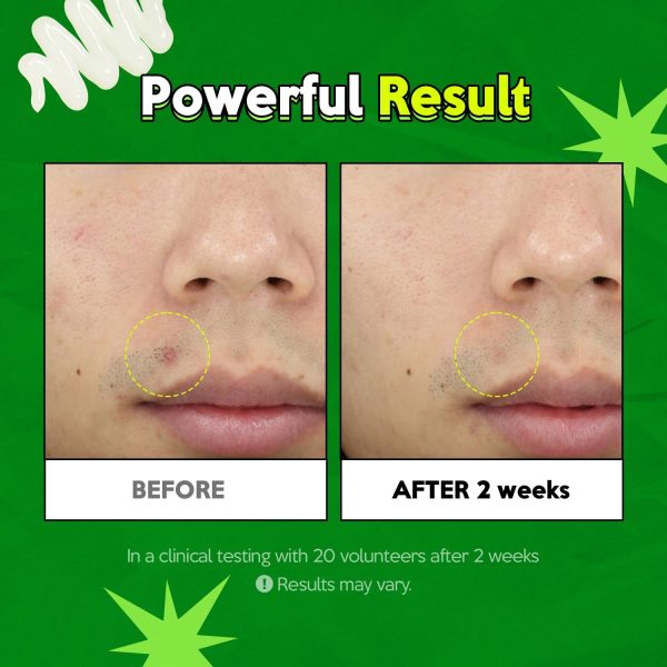 ⁦تروبليس علاج بقع شجرة الشاي - علاج البقع للبشرة الحساسة، جل البقع للبثور، جل العناية بالبقع، علاج البثور، العناية المكثفة للبقع، بدون عطر، 0.5 اونصة سائلة⁩ - الصورة ⁦5⁩