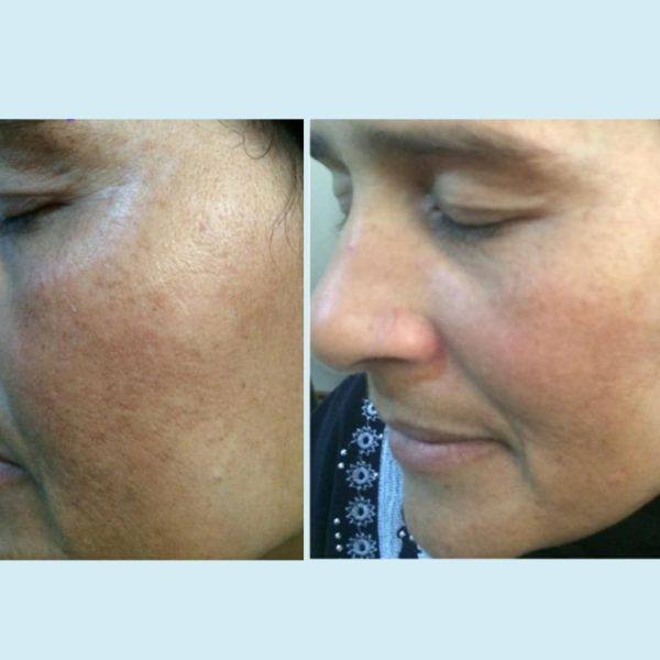⁦حمض اللاكتيك - جل مقشر - معزز بحمض الكوجيك ومستخلص التوت التقشير الكيميائي الاحترافي من بيرفيكت ايميج للنساء 0.3 رطل 0.3⁩ - الصورة ⁦4⁩
