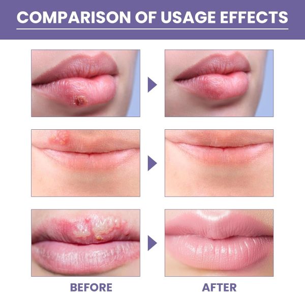 ⁦JDLYEVER Lip Care Patches 36Pcs for Treating Dry, Chapped, or Damaged Lips, Moisturizing and Nourishing Formula, Effective Smoothing and Repair, Comfortable and Non-Irritating, Fast-Acting Relief⁩ - الصورة ⁦4⁩