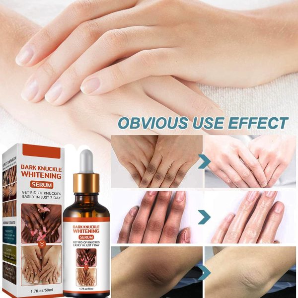 ⁦KOAHDE Hand Knuckle Whitening Serums,Knuckle Skin Lightening Serums,Dark Knuckle Whitening Serums,Dark Knuckle Corrector Serums,Removing Dark Spots Essence,Acanthosis Nigricans Whitening Oil,50ML⁩ - الصورة ⁦7⁩