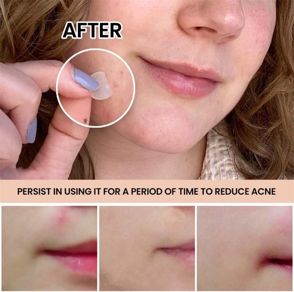 ⁦Acne Pimple Patch, Absorbing Hydrocolloid Original, Hydrocolloid Acne Pimple Patch, Patches for Blemishes and Zits Cover, Spot Stickers for Face and Body, 3 Size, Vegan and Cruelty Free (10 Count)⁩ - الصورة ⁦2⁩