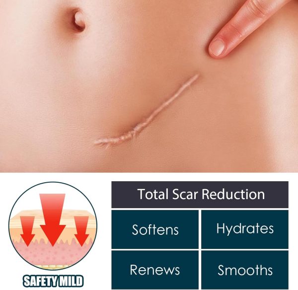 ⁦JDLYEVER Fade Scar Gel 50ml Surgical Scars Skin Hyperplasia Burning Nursing Care Smoothing Scars Repairing Scars, Moisturizing & Hydrating Ingredients Soothe & Nurture Skin, Non-Greasy All Skin Types⁩ - الصورة ⁦7⁩