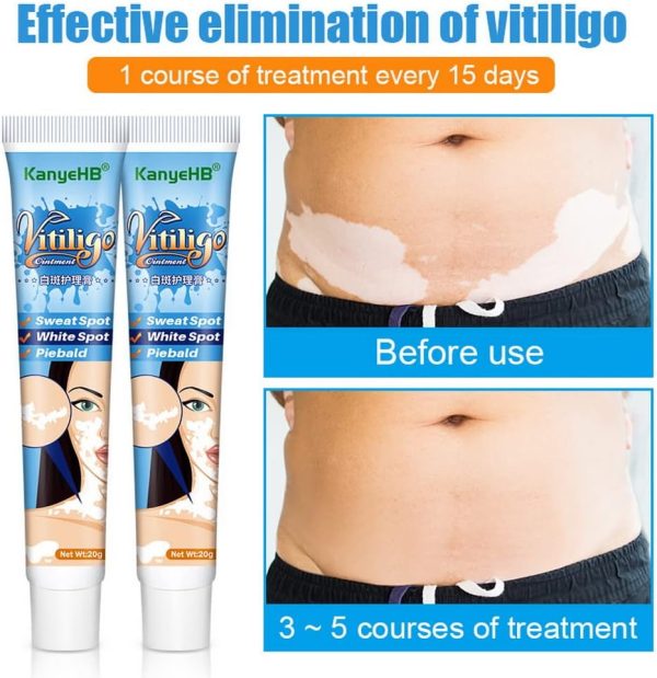 ⁦Vitiligo Cream, Vitiligo Treatment, Vitiligo Care Cream for Skin Vitiligo, Psoriasis, Leukoplakia, Reduces White Spots, Improve Skin Pigmentation Regulating (Pack of 1)⁩ - الصورة ⁦5⁩