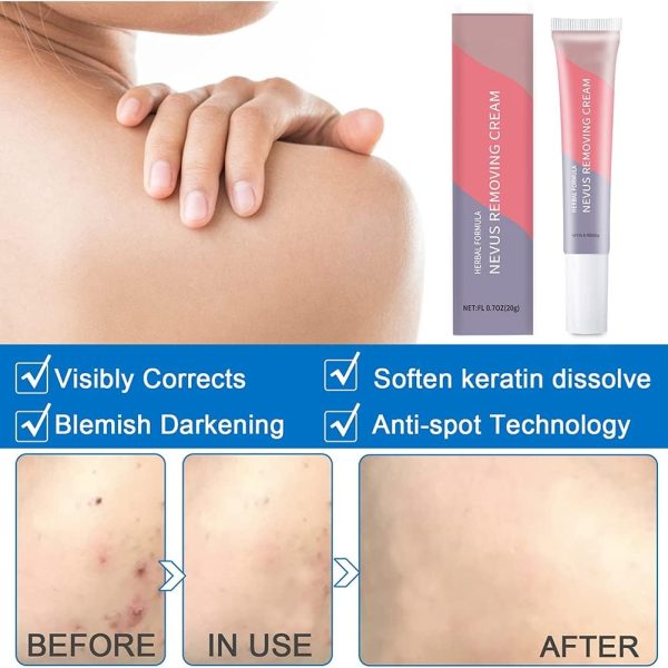 ⁦Skin Tag Remover, Warts & Mole Remover Cream- Quickly and Easily Remove Common Skin Tag, Wart and Callus - Enriched with All Natural Ingredients,Effective and Scar-Fre.⁩ - الصورة ⁦4⁩