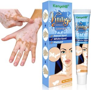 Vitiligo Cream, Vitiligo Treatment, Vitiligo Care Cream for Skin Vitiligo, Psoriasis, Leukoplakia, Reduces White Spots, Improve Skin Pigmentation Regulating (Pack of 1)