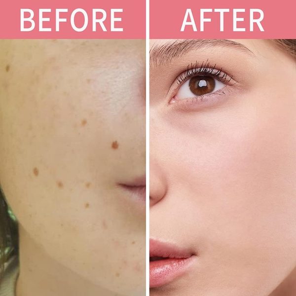 ⁦Skin Tag Remover, Warts & Mole Remover Cream- Quickly and Easily Remove Common Skin Tag, Wart and Callus - Enriched with All Natural Ingredients,Effective and Scar-Fre.⁩ - الصورة ⁦3⁩