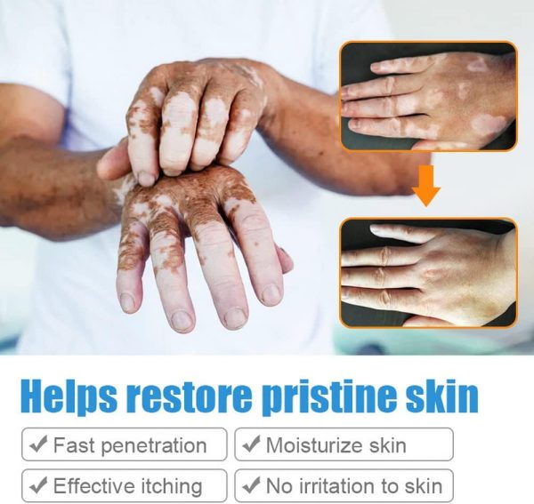 ⁦Vitiligo Cream, Vitiligo Treatment, Vitiligo Care Cream for Skin Vitiligo, Psoriasis, Leukoplakia, Reduces White Spots, Improve Skin Pigmentation Regulating (Pack of 1)⁩ - الصورة ⁦3⁩