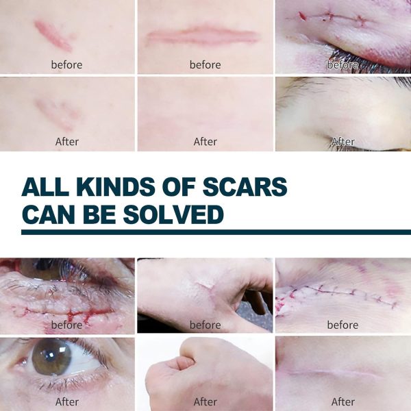 ⁦JDLYEVER Fade Scar Gel 50ml Surgical Scars Skin Hyperplasia Burning Nursing Care Smoothing Scars Repairing Scars, Moisturizing & Hydrating Ingredients Soothe & Nurture Skin, Non-Greasy All Skin Types⁩ - الصورة ⁦8⁩