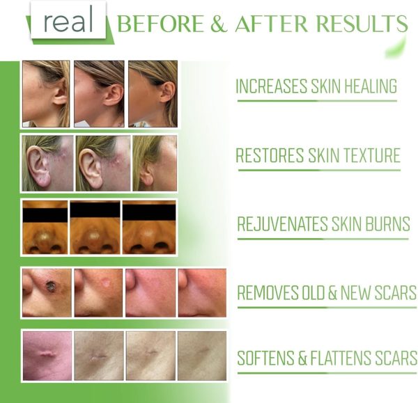 ⁦Dr Speron's Natural Skincare Scar Removal Cream For New & Old Scars, Advanced Silicone Scar Gel For Surgical Scars, Pimples, Burns, And Dark Spots - 1.41oz⁩ - الصورة ⁦7⁩
