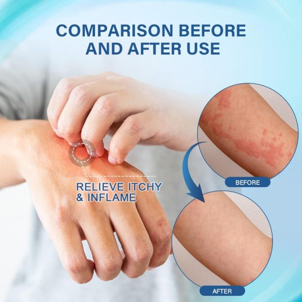 ⁦NOVOLAN Allergy Care Cream - 20g Anti-Allergy Relief Ointment for Skin Itch, Bug Bites, Fungal Infections, & Irritation - Provides Soothing Relief from Itching & Inflammation - Hypoallergenic Formula⁩ - الصورة ⁦4⁩