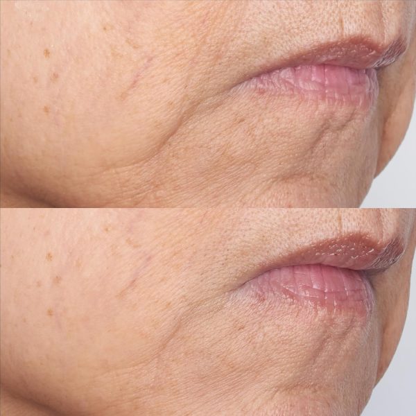 ⁦Perricone MD Cold Plasma Plus+ The Intensive Gel Mask | Ultra-Hydrating & Cooling | Improves uneven texture, wrinkles, loss of radiance & firmness. Leaves skin instantly hydrated, soft & supple⁩ - الصورة ⁦4⁩