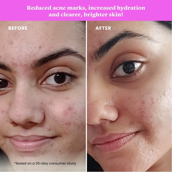 ⁦Foxtale 12% Niacinamide Face Serum with Azelaic Acid for Oil Control & Brightening | Reduces Acne, Blemishes & Acne Marks | Brightens & Smoothens Skin | Face Serum for Women & Men | 30 ml⁩ - الصورة ⁦5⁩