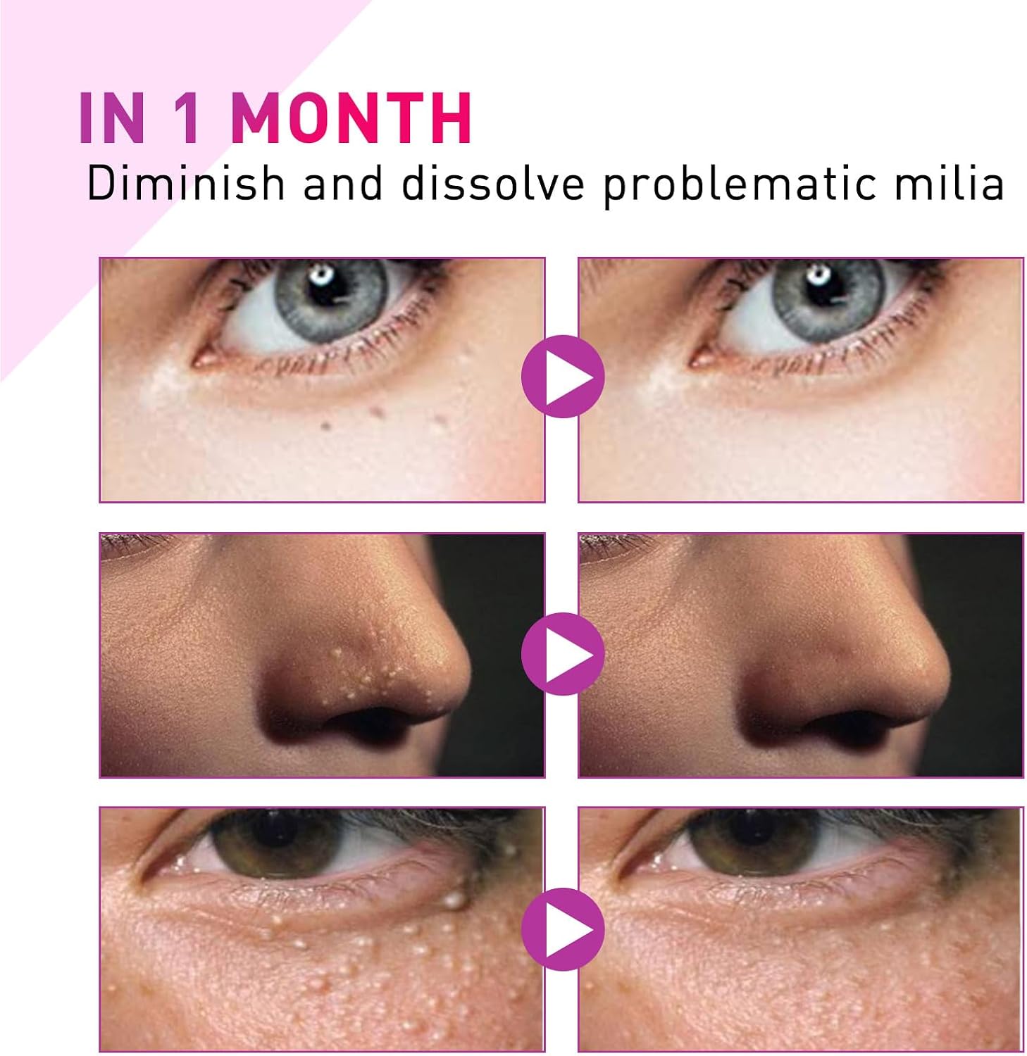 Milia Removal Spot Care,Fat Particle Eye Serum,Eye Serum for Dark Circles Puffiness,Milia Spot Reduce Face Serums,Milia Treatment Spot Remover for Face,30ml,including Cotton Pads Makeup 4 Milia Removal Spot Care,Fat Particle Eye Serum,Eye Serum for Dark Circles Puffiness,Milia Spot Reduce Face Serums,Milia Treatment Spot Remover for Face,30ml,including Cotton Pads Makeup - الصورة 4