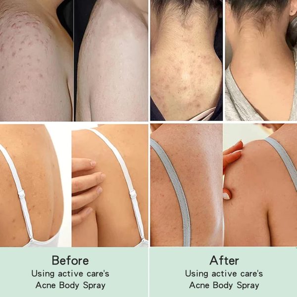 ⁦Azonee Clarifying Body Spray – With 2% Salicylic Acid & Tea Tree Oil, Refreshing Herbal Formula for Smooth & Balanced Skin, Fast-Absorbing & Non-Greasy Mist for Daily Skin Care (2Pcs)⁩ - الصورة ⁦6⁩