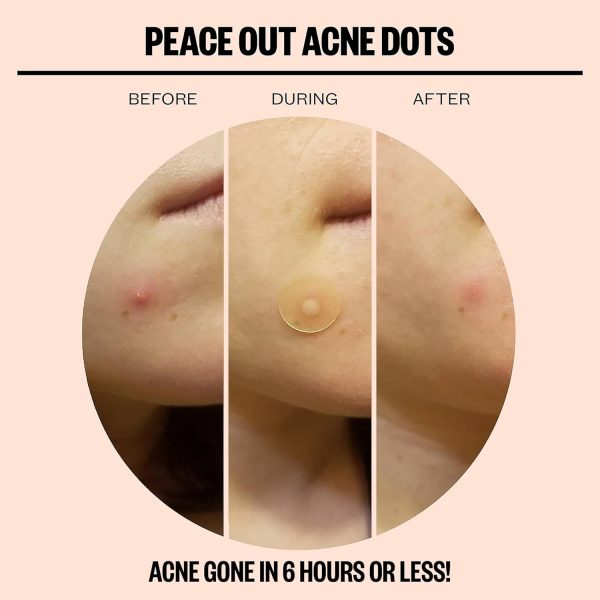 ⁦PEACE OUT Skincare Acne Dots, Hydrocolloid Pimple Patches Help Clear Blemishes Overnight, Award Winning Fast Acting Anti-Acne Solution (10 dots)⁩ - الصورة ⁦5⁩