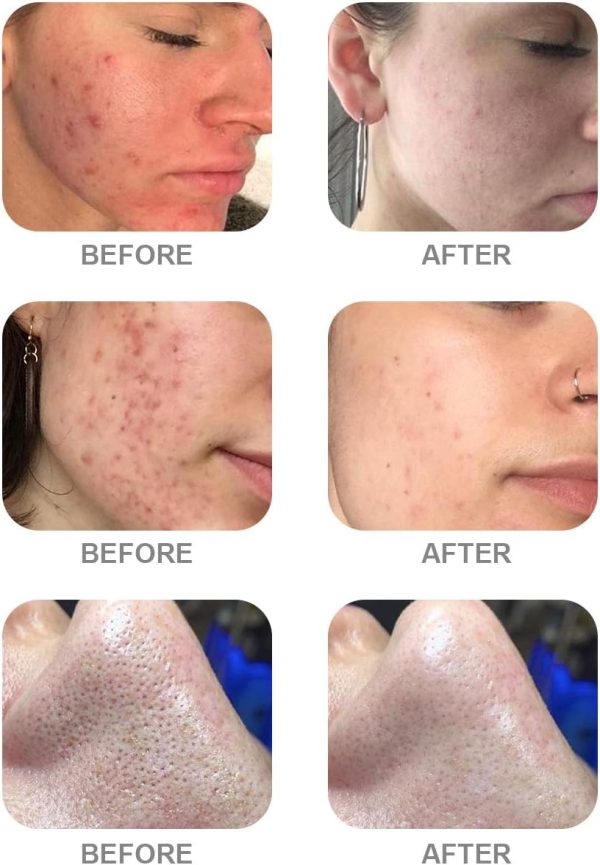 ⁦NUFR AS1 SA2 AO3 Small Bubble Solution, Skin Care Facial Serum Aqua Peeling Solution 3x400ml, Hydrafacial Machine Solution for Cleaning Face & Salon⁩ - الصورة ⁦3⁩