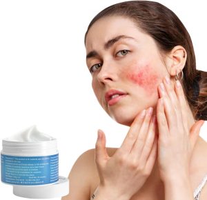 JDLYEVER Rosacea Relief Ointment 100g Soothing Skin Care Cream for Redness and Inflammation, Effective Treatment for Rosacea, Acne, and Dermatitis, Calms Flushing and Blemishes, for Daily Facial Care