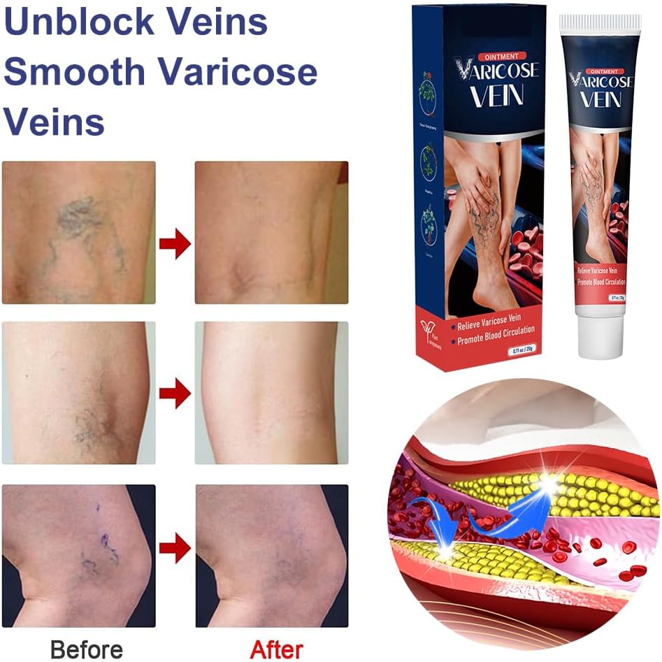 Varicose Veins Cream, Varicose Veins Ointment, Strengthening Capillary Health, Improving Blood Circulation 6 Varicose Veins Cream, Varicose Veins Ointment, Strengthening Capillary Health, Improving Blood Circulation - الصورة 6