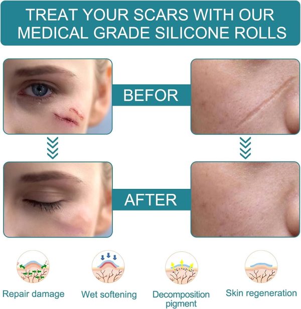 ⁦Goreem Silicone Scar Sheets for Keloid & Burns (1.5 Meter*2) Grade Soft Silicone Gel Tape for Scar Removal - Painless Solution for Scars, Acne Scars & Wound Care⁩ - الصورة ⁦3⁩