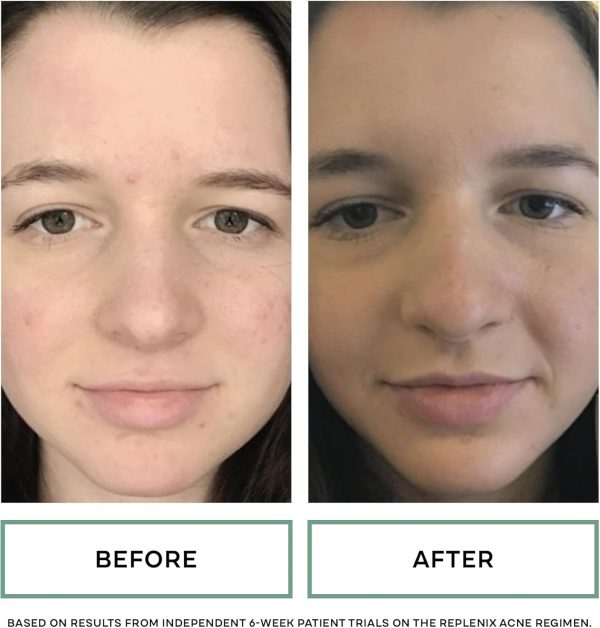 ⁦Replenix Gly-Sal 5-2 Deep Pore Cleanser 200ml⁩ - الصورة ⁦4⁩