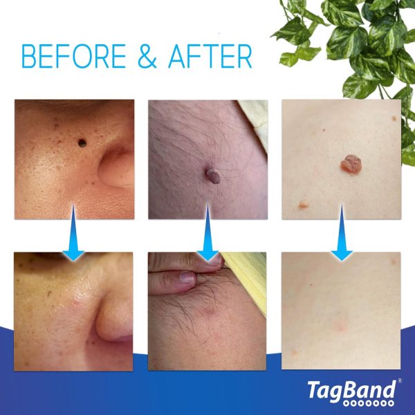 ⁦Auto TagBand Micro Skin Tag Remover Device for Small Skin Tags. Easy Application in Minutes (includes 10x Removal Bands & Cleansing Wipes)⁩ - الصورة ⁦2⁩