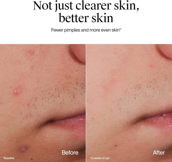 ⁦Neutrogena Oil-Free Acne Face Wash, Fragrance Free, Sensitive Skin Facial Cleanser with 2% Salicylic Acid Acne Treatment for Face, 9.1 Fl Oz⁩ - الصورة ⁦7⁩