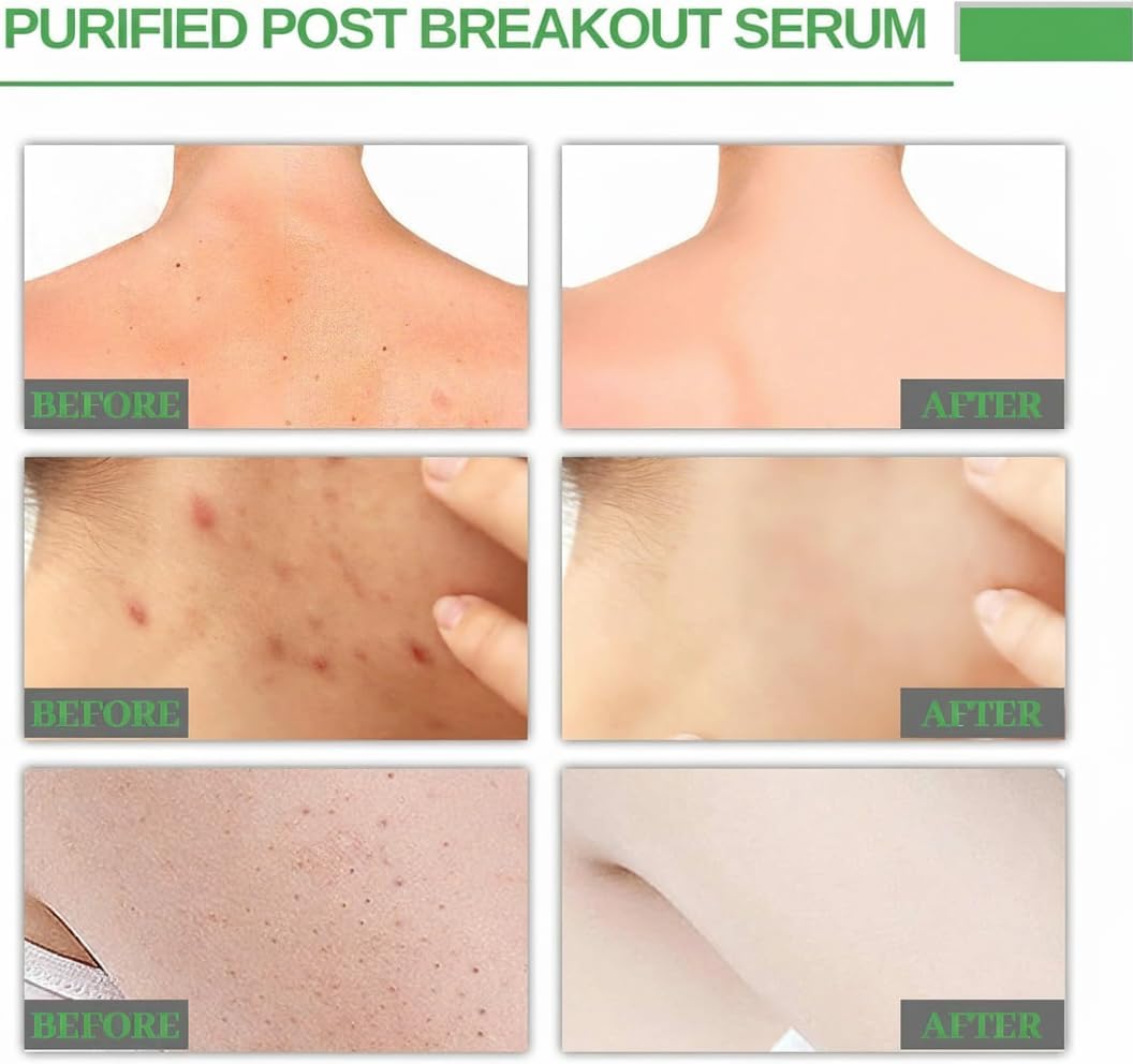 خلاصة الوجه لاصلاح البقع الداكنة من ازوني، مزيل بقع الشيخوخة في الوجه، منتجات ايسنس للعناية بالبشرة، يحتوي على زيت شجرة الشاي وفيتامين E ويضيء لون البشرة ويوحد لون البشرة ويصلح البقع الداكنة المضادة 5 خلاصة الوجه لاصلاح البقع الداكنة من ازوني، مزيل بقع الشيخوخة في الوجه، منتجات ايسنس للعناية بالبشرة، يحتوي على زيت شجرة الشاي وفيتامين E ويضيء لون البشرة ويوحد لون البشرة ويصلح البقع الداكنة المضادة - الصورة 5