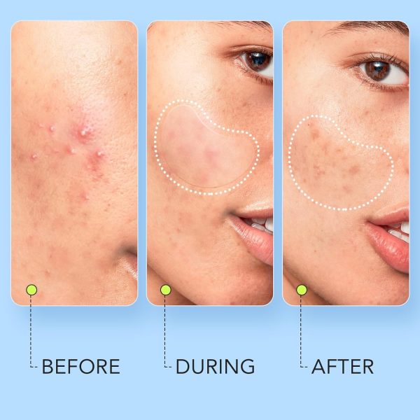 ⁦LitBear Large Pimple Patches (7 Sizes 112 Counts), Big Acne Patches, XL Hydrocolloid Bandages for Full Face, Forehead, Chin, Nose, Body, Back, Neck & Chest, Oval, Moon, Square hydrocolloid Patch⁩ - الصورة ⁦4⁩