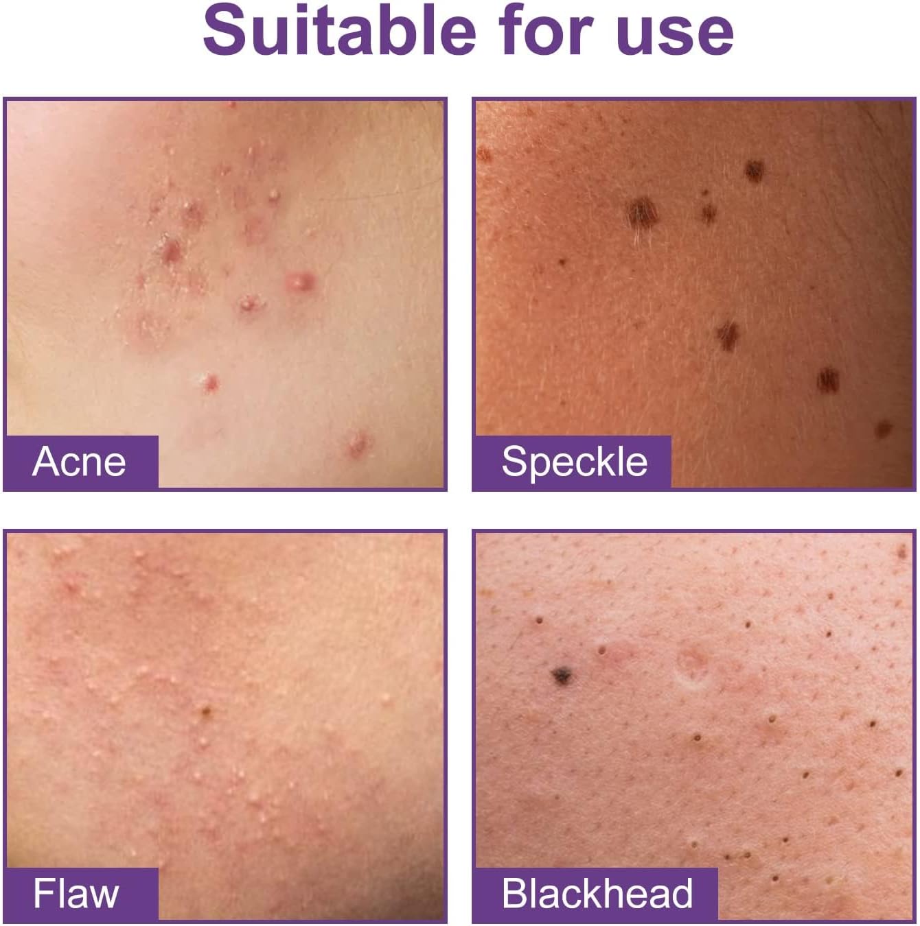 رقع بثور على شكل نجوم، 180 رقعة بثرة للوجه، رقع حب الشباب الغروانية المائية، رقع البثور والنجوم، رقع زيت لزيتس والعيوب والكسر، مقاومة للماء وجيدة التهوية للبشرة المعرضة لحب الشباب 5 رقع بثور على شكل نجوم، 180 رقعة بثرة للوجه، رقع حب الشباب الغروانية المائية، رقع البثور والنجوم، رقع زيت لزيتس والعيوب والكسر، مقاومة للماء وجيدة التهوية للبشرة المعرضة لحب الشباب - الصورة 5