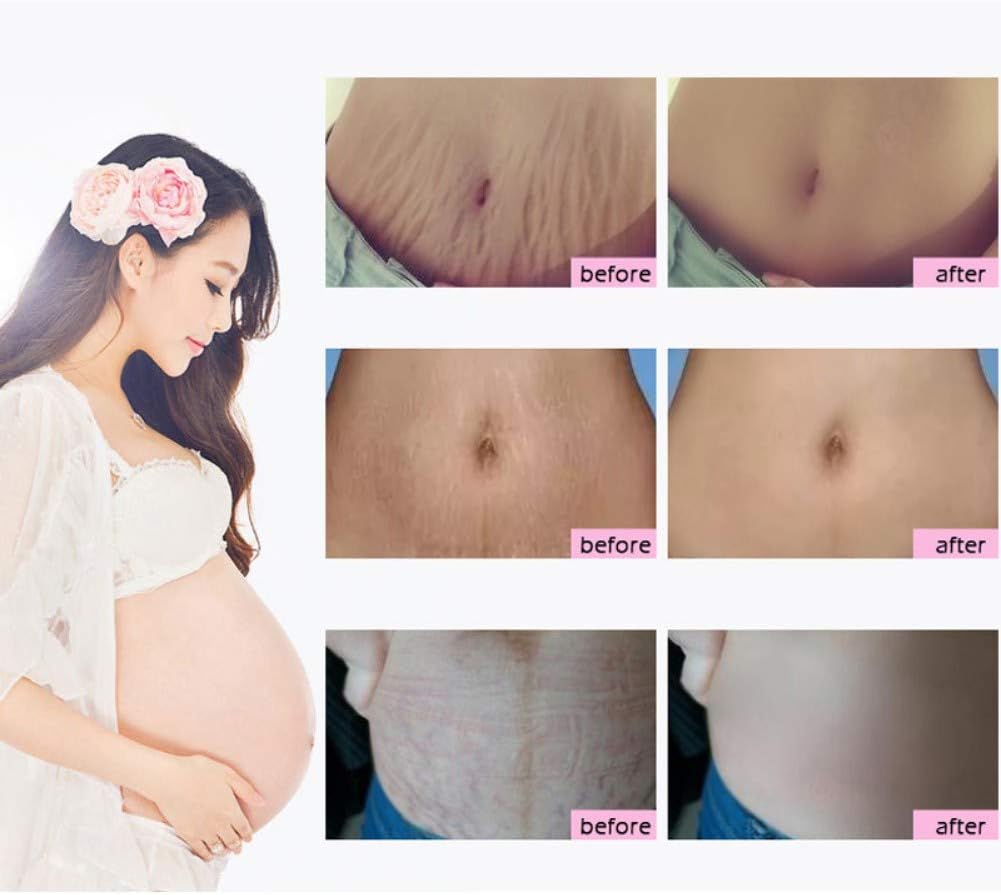 كريم علامات التمدد، يزيل ندبات الحمل، علاج علامات التمدد، اصلاح الأمومة، يزيل علامات التمدد من الحمل، اصلاح الندبات المتراخية وعلامات تمدد البطن 5 كريم علامات التمدد، يزيل ندبات الحمل، علاج علامات التمدد، اصلاح الأمومة، يزيل علامات التمدد من الحمل، اصلاح الندبات المتراخية وعلامات تمدد البطن - الصورة 5