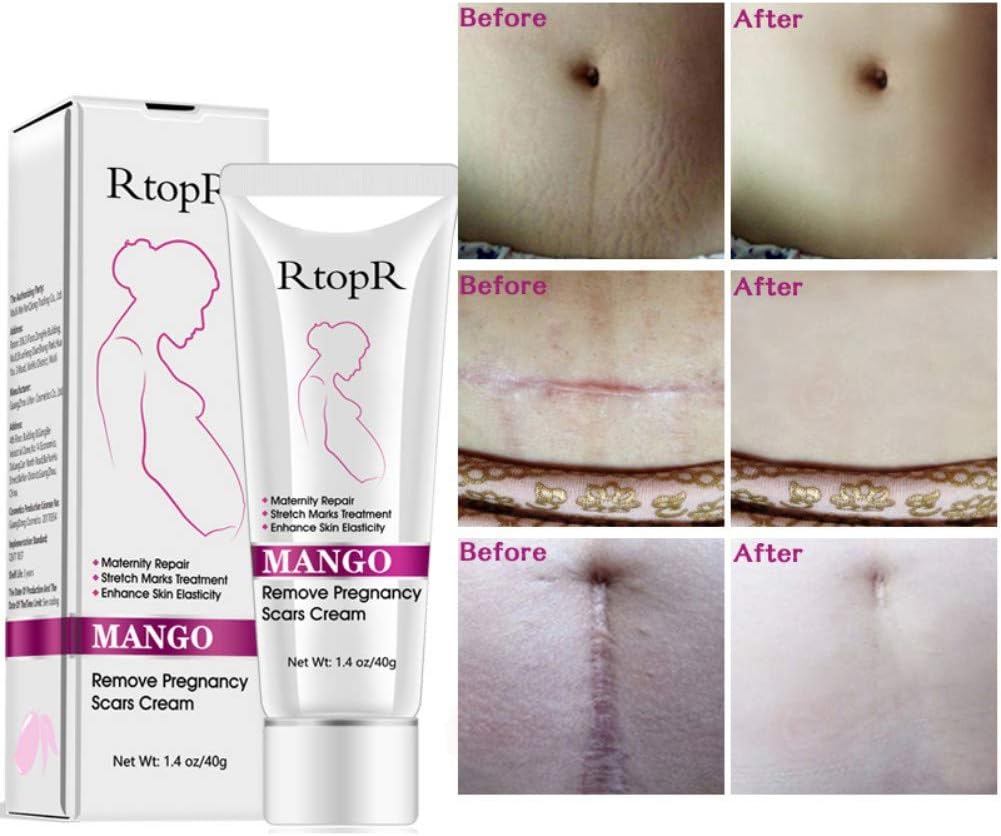كريم علامات التمدد، يزيل ندبات الحمل، علاج علامات التمدد، اصلاح الأمومة، يزيل علامات التمدد من الحمل، اصلاح الندبات المتراخية وعلامات تمدد البطن 3 كريم علامات التمدد، يزيل ندبات الحمل، علاج علامات التمدد، اصلاح الأمومة، يزيل علامات التمدد من الحمل، اصلاح الندبات المتراخية وعلامات تمدد البطن - الصورة 3
