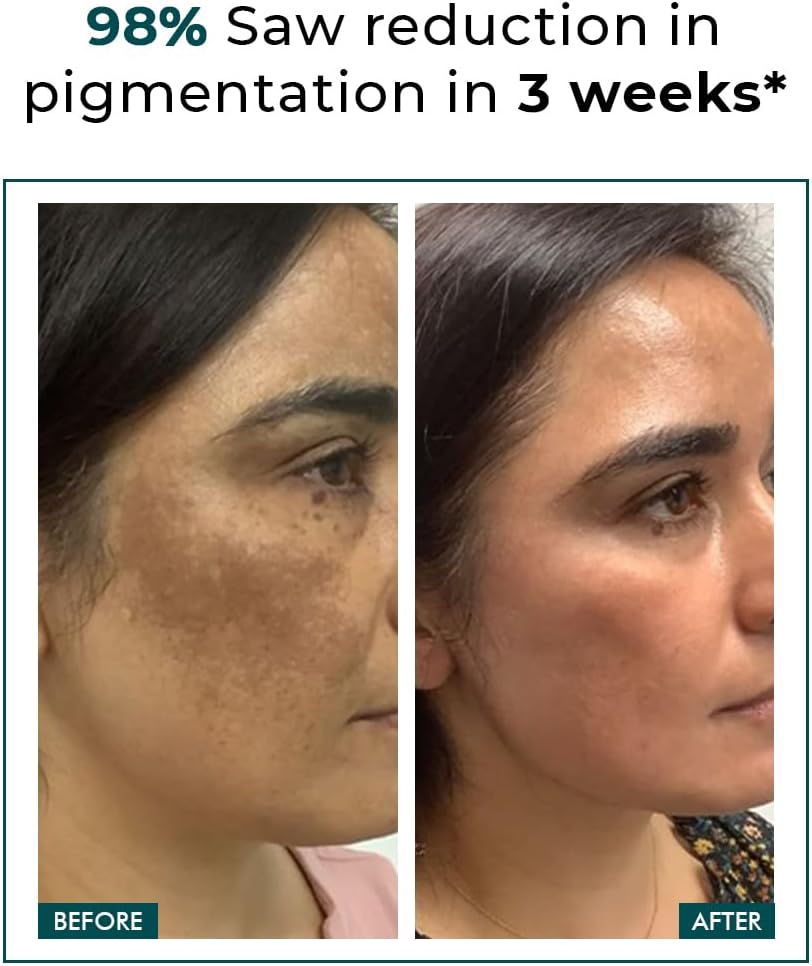 كريم للوجه من كونشس كيمست لإزالة التصبغات والبقع الداكنة، مناسب لجميع أنواع البشرة، 50 جرام 2 كريم للوجه من كونشس كيمست لإزالة التصبغات والبقع الداكنة، مناسب لجميع أنواع البشرة، 50 جرام - الصورة 2