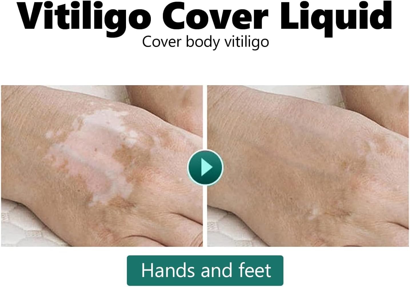 سائل لتغطية البهاق 20 مل، غطاء سائل مقاوم للماء للبهاق، كونسيلر بلون البشرة 5 سائل لتغطية البهاق 20 مل، غطاء سائل مقاوم للماء للبهاق، كونسيلر بلون البشرة - الصورة 5