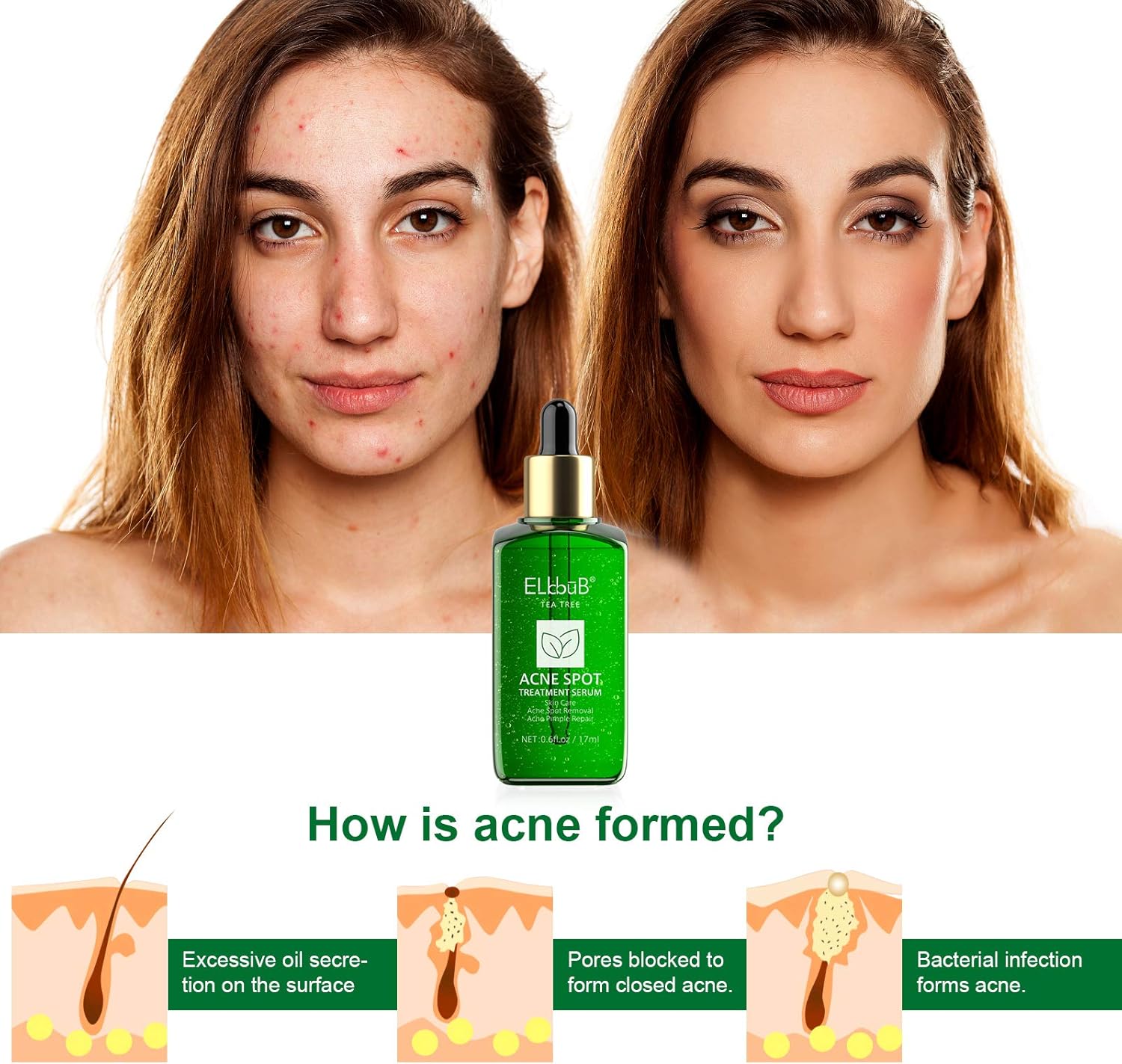 ال بوب مصل علاجات حب الشباب لعلاج بقع حب الشباب، مصل البشرة الشفافة لشجرة الشاي لإزالة حب الشباب الشديد والكسر والبثور وإصلاح البشرة 7 ال بوب مصل علاجات حب الشباب لعلاج بقع حب الشباب، مصل البشرة الشفافة لشجرة الشاي لإزالة حب الشباب الشديد والكسر والبثور وإصلاح البشرة - الصورة 7