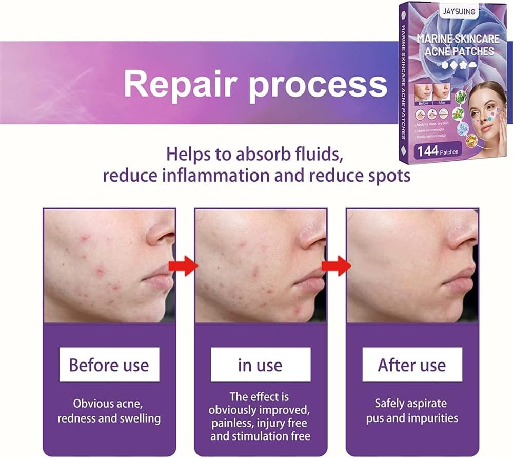 رقع حب الشباب للوجه بخلاصة الطحالب الخضراء الطبيعية وزيت شجرة الشاي الغروانية المائية رقعة تغطية ماصة لحب على شكل نجمة ملونة تغطي وتقلل من النتوءات والبثور 144 نيو تايملي 7 رقع حب الشباب للوجه بخلاصة الطحالب الخضراء الطبيعية وزيت شجرة الشاي الغروانية المائية رقعة تغطية ماصة لحب على شكل نجمة ملونة تغطي وتقلل من النتوءات والبثور 144 نيو تايملي - الصورة 7